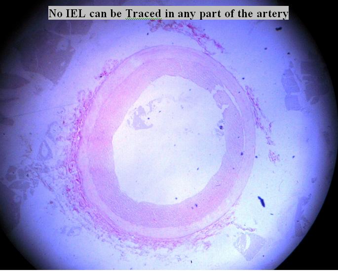 Figure 6: Showing Grade-III Degeneration of Internal Elastic Lamina (IEL).