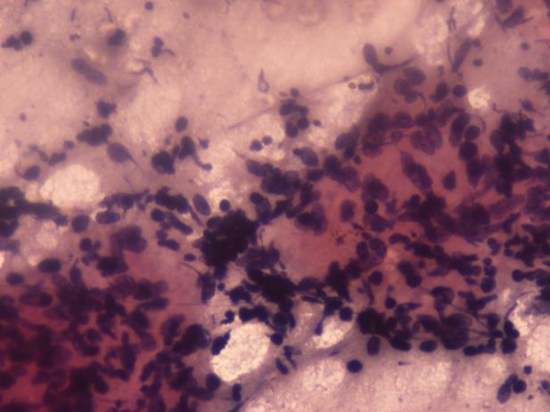 Figure 1: FNA cytology from the lip ulcer showed a necrotic background with clusters of epithelioid cells and scattered atypical squamous cells. Papanicolaou x 10X.