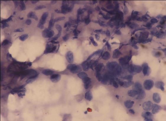Figure 2: FNAC of the lesion was characterized by the presence of scattered caseating epithelioid cell granulomas with typical slipper shaped cells with vesicular nuclear chromatin admixed with pleomorphic squamous cells. Papanicolaou x 40X.