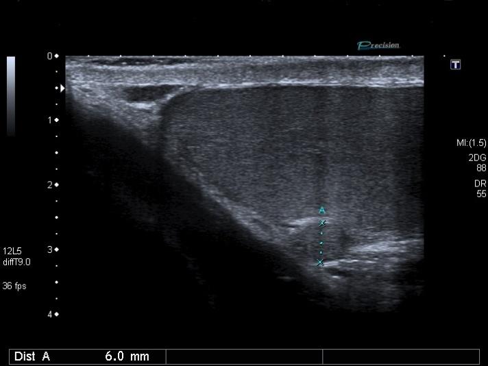 Figure 1: Well-defined 6 mm paratesticular lesion independent of the surrounding structures.