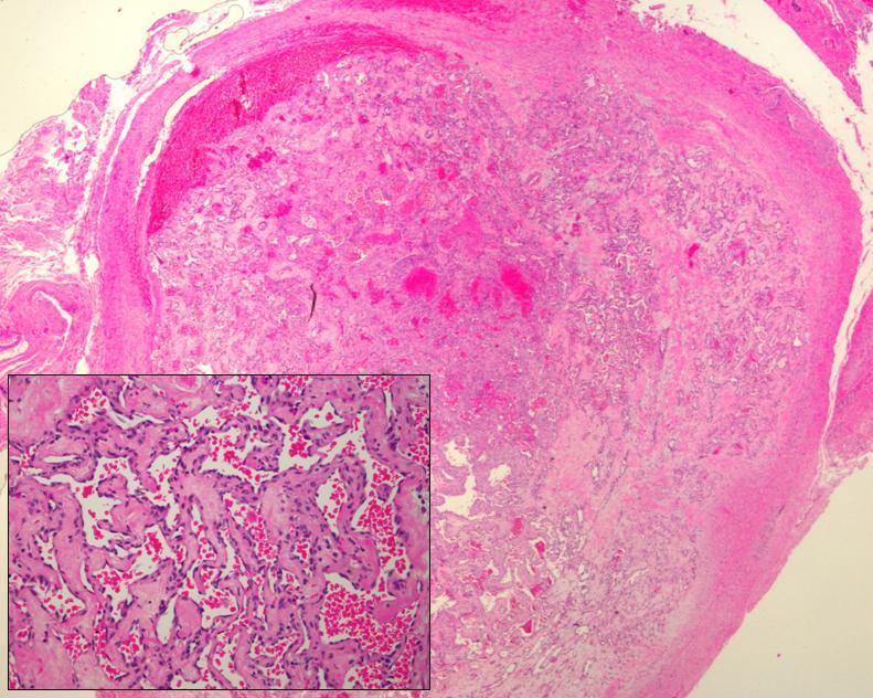 Figure 3: Vascular structure with epithelial proliferation in a papillary pattern without atypia. These findings are characteristic of Masson’s hemangioma. (H&E, panoramic view 40X, detail 200x).