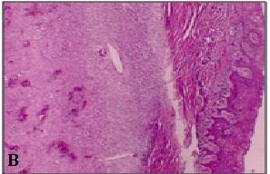 Figure 2: Second visit of patient: A-Intraoral view; B-Photomicrograph of the biopsy of the lesion under 10X view showing foci of ossification in the background of highly cellular fibroblastic connective tissue; C- Photomicrograph of the biopsy of the lesion under 40X view showing plump fibroblast with myxoid stroma confirming diagnosis of aggressive ossifying fibroma.
