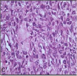Figure 3: Third visit of patient: A-Extraoral view; B-Intraoral view; C-Gross Specimen; D-Photomicrograph of the biopsy of the lesion under 10X view showing foci of ossification in the background of highly cellular fibroblastic connective tissue; E, F-Photomicrograph of the biopsy of the lesion under 40X view showing tumor osteoid with dysplastic osteoblast and fibroblast confirming diagnosis of Low grade Osteosarcoma.