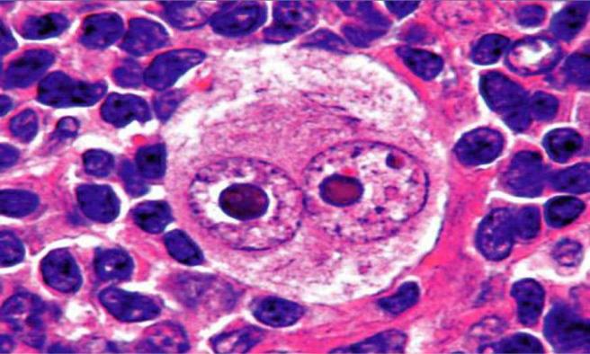 Figure 2: Reed Sternberg cells- Mirror image nuclei with prominent nucleoli [22].