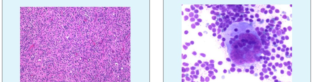 Figure 5: Lymphocyte Depletion Hodgkin’s Lymphoma [24].