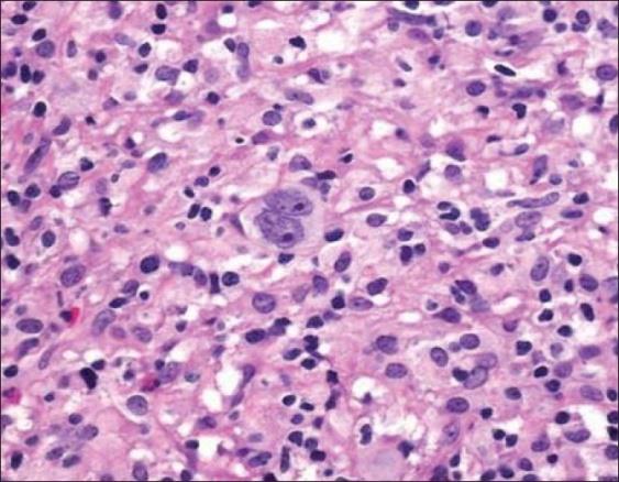 Figure 6: Lacunar Cells- Nodular Sclerosis Hodgkin’s Lymphoma [25].