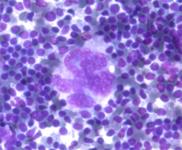 Figure 7: Reed Sternberg cell- aspiration cytology [26].