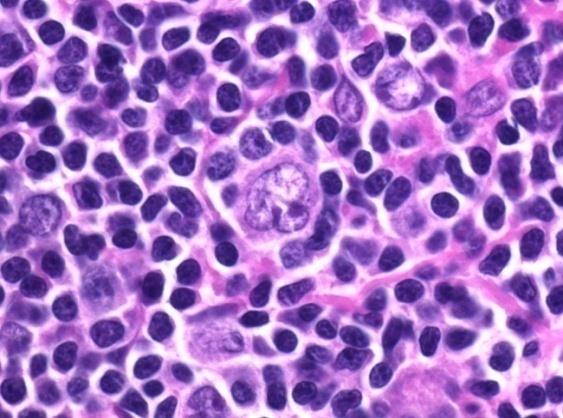 Figure 8: Poly-lobed Reed Sternberg cell with multinuclear cells and prominent nucleoli-aspiration cytology [26].
