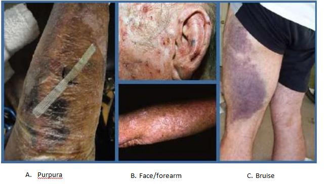 Figure 12: “Snow flake” dandruff is a sign of essential fatty acid deficiency. It usually occurs first on the anterior lower leg, but as severity increases it can also be found on the upper extremities and even the neck.