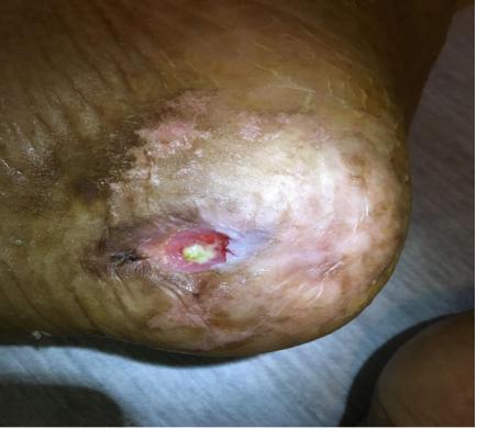 Figure 18: A) Eschar removal.