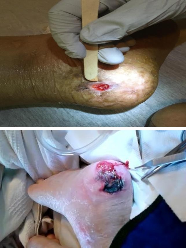 Figure 19: A) Result of aggressivedebridement once considered standard, followed by odor control using dakon’s solution and non healing for 10 years. The pink tissue are areas of healing representing an early result with The Three Pillar Protocol.