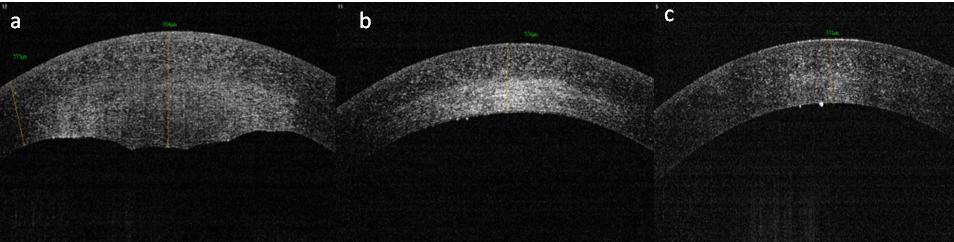 Figure 1: Case-1: ASOCT image of cornea of a patient with disciform keratitis (a) Before starting treatment; (b) Two weeks after starting treatment; (c) One month after starting treatment