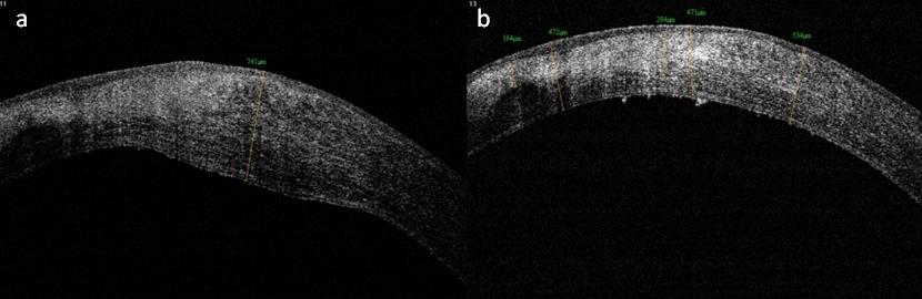 Figure 4: Case-4 ASOCT images. (a) Before starting treatment; (b) 02 month after starting treatment