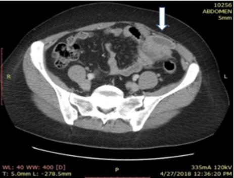 Figure 1: Left side Spigelian hernia containing an incarcerated left ovary with fluid collection (white arrow).