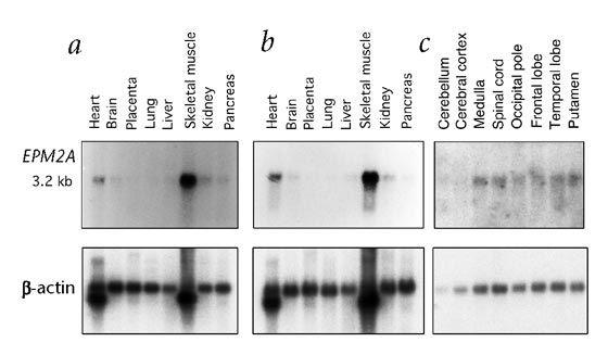 Figure 10: Images of EPM2A Protein Formation Pattern in Normal Mode and Patients with Adult-onset Leukoencephalopathy with Axonal Spheroids and Pigmented Glia Syndrome.