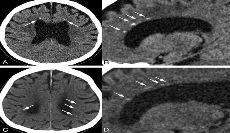 Figure 4: Radiological Image of Brain Diseases in Patients with Adult-onset Leukoencephalopathy with Axonal Spheroids and Pigmented Glia Syndrome.