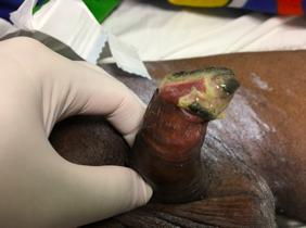 Figure 2: Ulcerated lesion in glans and balanopreputial sulcus with infection associated