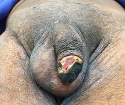 Figure 4: Characteristic lesions of penile calciphylaxis