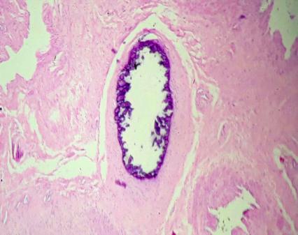 Figure 5: Characteristic lesions of calcification of small vessels, endovascular fibrosis, panniculitis, necrosis and thrombosis
