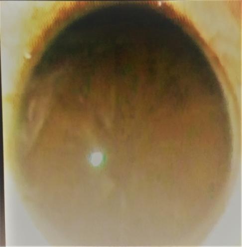 Figure 1: showing absence of pupil.