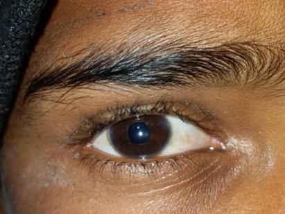 Figure 3: Showing 4mm pupil following pupilloplasty.