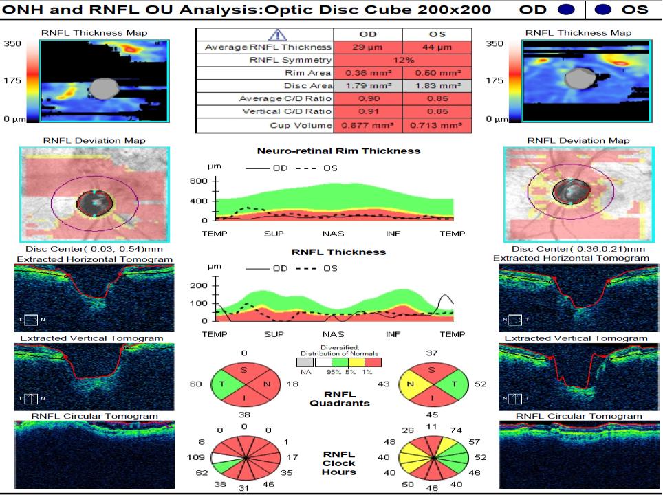 Figure 4: Retinal Nerve Fibre Layer Thickness by Spectral Domain Optical coherence Tomography in a Glaucomatous patient.