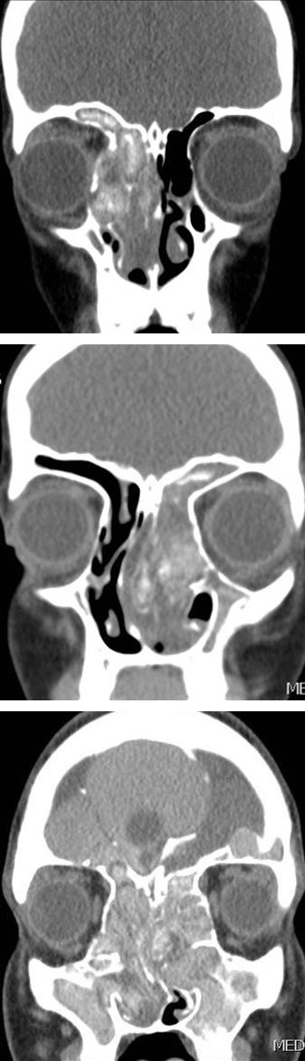Figure 7: Coronal CT images without contrast show bilateral frontal sinuses and ethmoid air cells disease with expansion and bone dehiscence of the roof of the orbits and posterior wall of the frontal sinuses. It result in intraorbital and intracranial extension and bilateral proptosis.