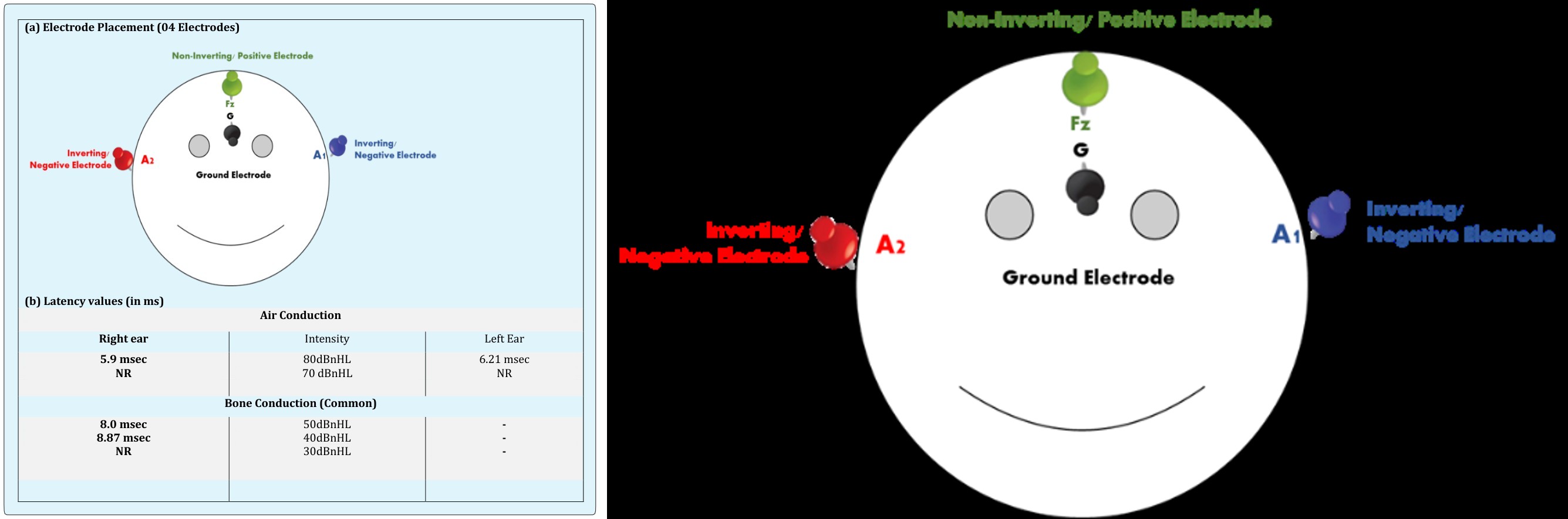 Figure 1: (a) Electrode Placement for recording Air conduction and Bone Conduction ABR; (b) Latency (in ms); & (c) Waveform of Air conduction & Bone conduction. Threshold sensitivity for both AC and BC are estimated as the lowest replicable wave V peak component. Masking was not performed due to bilateral aural atresia and hence, the integrity of individual cochlear function was not established. The minimum level where response were elicited was 80 dBnHL for AC and 40 dBnHL for BC indicating normal cochlear functioning i.e. moderately severe conductive hearing loss. The findings of the ABR play an important role in the audio logic and surgical management for our GS patients. All audio logical assessments were carried out in ANSI (S3.1.1999) specified environment.