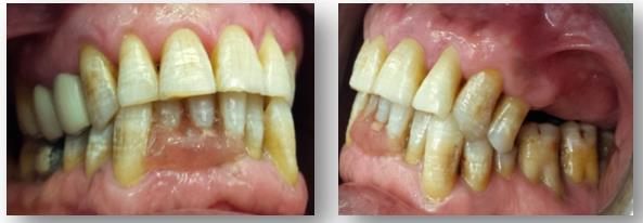 Figure 1: Closed mouth: right side. Figure 2: Closed mouth: left side.