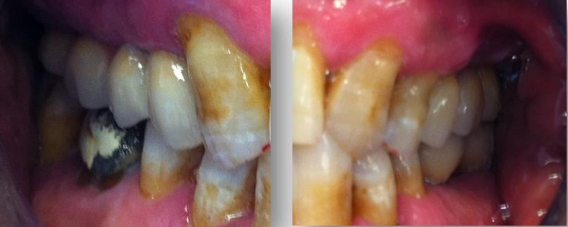 Figure 10: Retroalveolar X-rays: A: right maxillary sector; B: left mandibular sector; C: left maxillary sector.