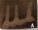 Figure 7: Retroalveolar X-rays: (A: Right Maxillary sector; B: Left maxillary sector; C: Right Mandibular sector).
