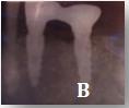 Figure 8: The cover screws were removed and the healing screws were placed.