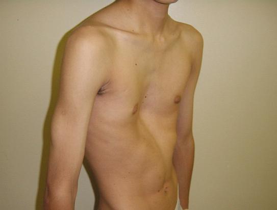 Figure 1: Pectus Excavatum (PEX).