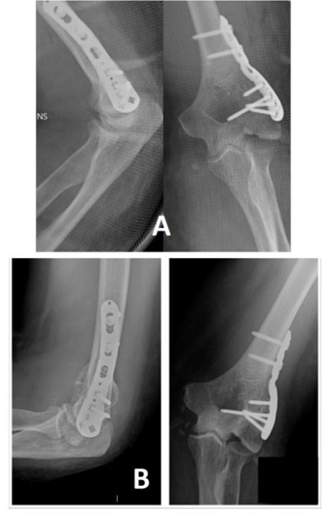 Figure 4: (A) Immediate post-operative radiograph showing recreation of the articular anatomy using Iliac bone graft, (B) Radiographs at 6 months showing fracture union.