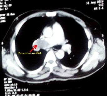 Figure 3: Proximal right pulmonary artery suggestive of thrombus.