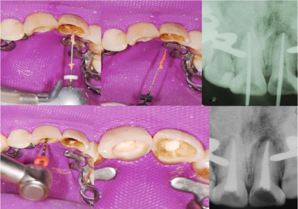 Figure 2: A and B: Removing guttapercha using Gates Glidden and Hedstroem files. D: Master GP adjustment. C: Canal instrumentation. E and F: Final obturation. After evaluating the root anatomy and throughout the evaluation of the coronary remaining it was decided to use a quartz fiber post system (Macro-Lock, RTD, France) for an intraradicular anchor; in order to achieve a better adaptation within the channel, follow the anatomy and achieve greater friction. Ducts were de-filled with Gates Glidden #2 and #3 (Dentsply Maillefer, Ballaigues, Switzerland), after that, Peeso #1 and the complete drilling sequence corresponding to the post system employed (Figure 3).
