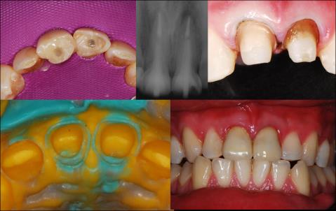 Figure 5: A and B: Cemented posts. C and D: Crowns preparation and impression using pvs material. E: Cemented crowns.