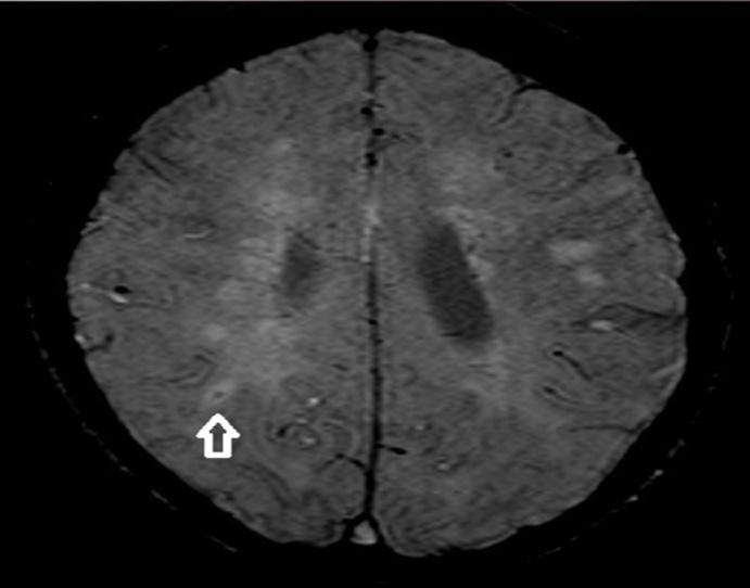 Figure 1: Central vein characterized by dark signal in center of hyper signal plaque in SWI (arrow).