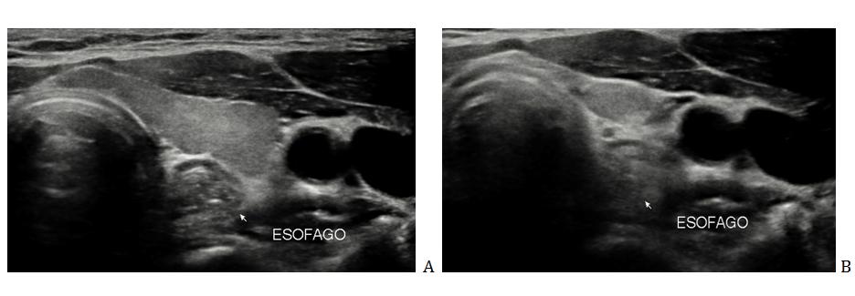 Figure 2: A) Left thyroid lobe with visualization of the esophagus, which gives the impression of calcium images inside. B) Swallowing patient, no longer observing esophagus as a previous image.