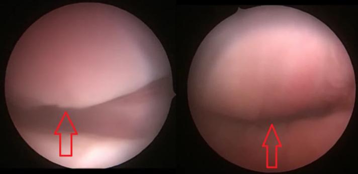 Figure 1: MRI identifying bladder neck lesion and presence of bladder catheter.