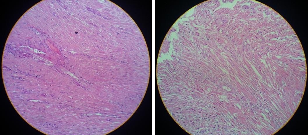 Figure 5: Histological section of the surgical specimen with a 200-fold increase.