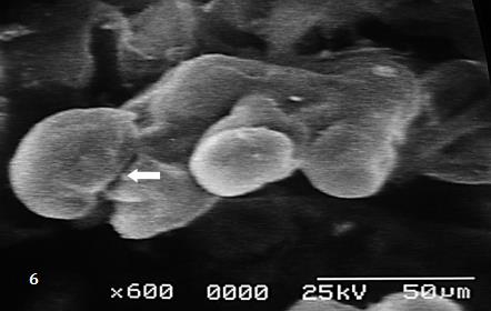 Figure 4: Curved mature intermediate villi are seen near of immature intermediate villi.