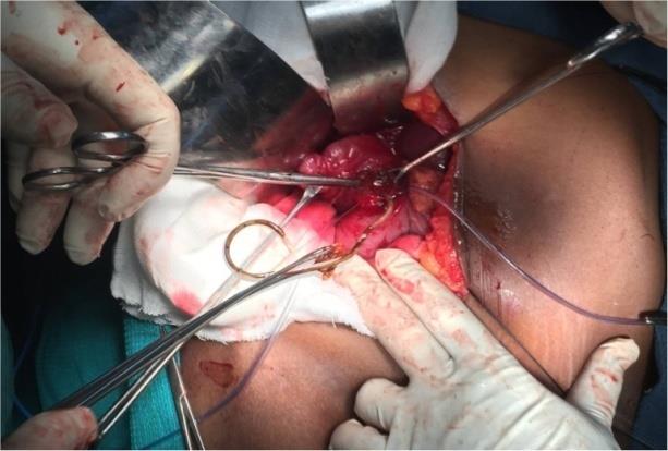 Figure 2: Intra Operative Picture Demonstrating Type 3 Mirizzi Syndrome (Blue Arrow) With Type F Bile Duct Anomaly Right Aberrant Duct Joining Cystic Duct (Red Arrow).