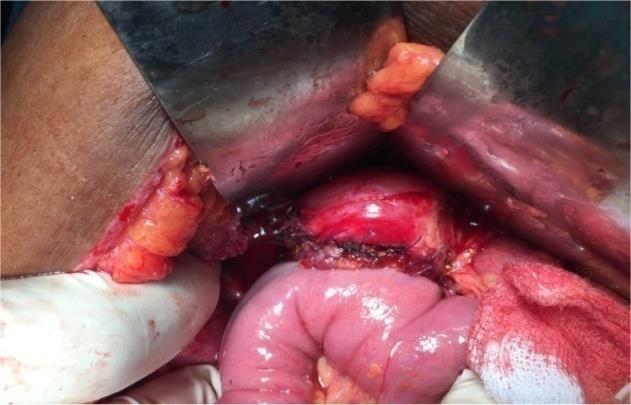 Figure 5: Completed Hepaticojejunostomy anastamosis.