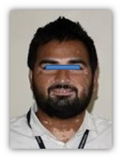 Figure 1: Patient with Vitiligo manifestation.