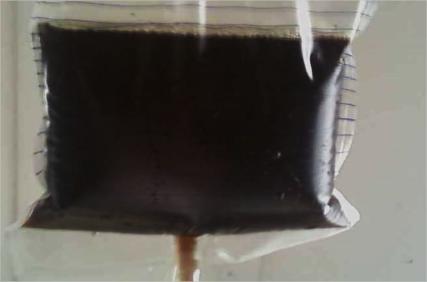 Figure 1: Blackish coloration of urine, J2 after ingestion of