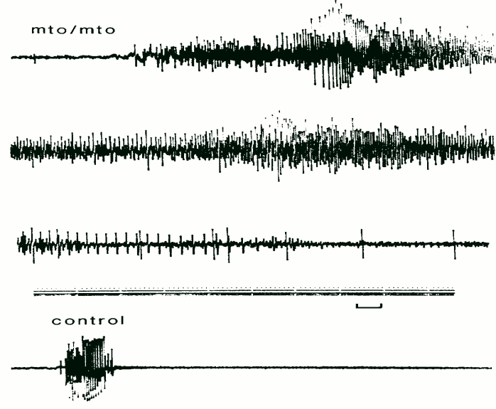 Figure 1: Patient's EMG with myotonia; percussion myotonia.