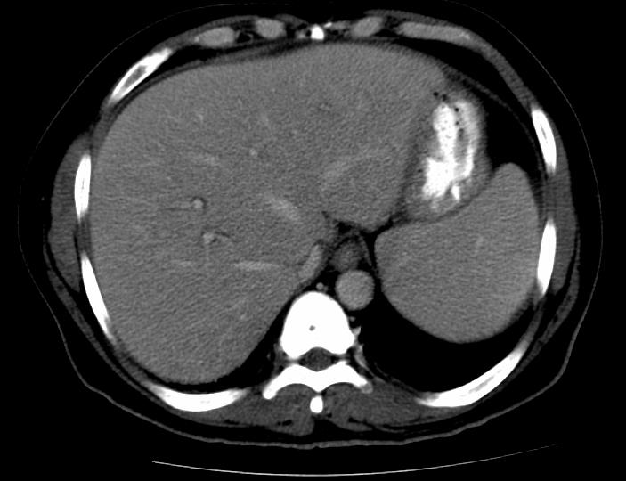Figure 1: Axial CT image showing hepatomegaly and mild splenomegaly. No enhancing mass or pathological lymphadenopathy noted in the perihepatic or perisplenic regions.