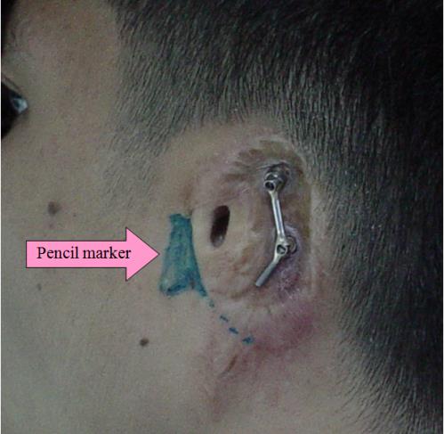 Figure 2: Mark the position of the condyle to identify the most movable tissue bed for locating the anterior margin of the prosthesis.