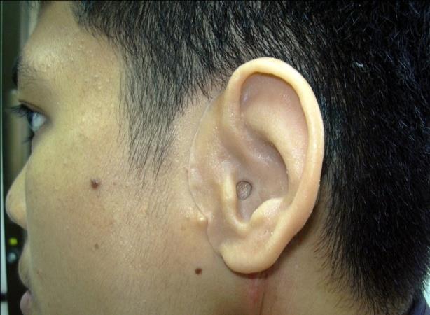 Figure 8: Definitive auricular prosthesis on the patient.